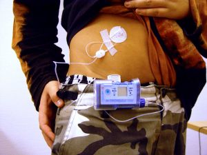 Die Insulinpumpe soll in jeder Situation bequem und sicher getragen werden können. Dafür gibt es spezielle Tragesysteme, mit denen die Pumpe z.B. am Gürtel befestigt werden kann.